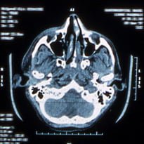 Glasgow pilots brain injuries study