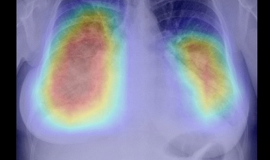 NHS team reports potential for AI in rapid detection of lung cancer
