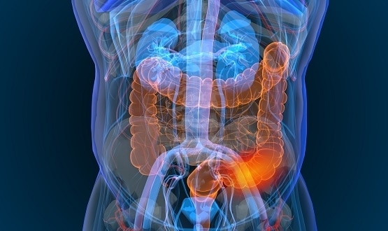 iPLATO awarded SBRI contract to improve bowel cancer screening rates