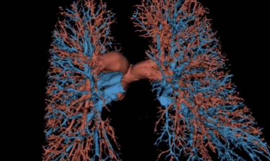 Qureight aims to reduce racial inequalities in lung disease treatment